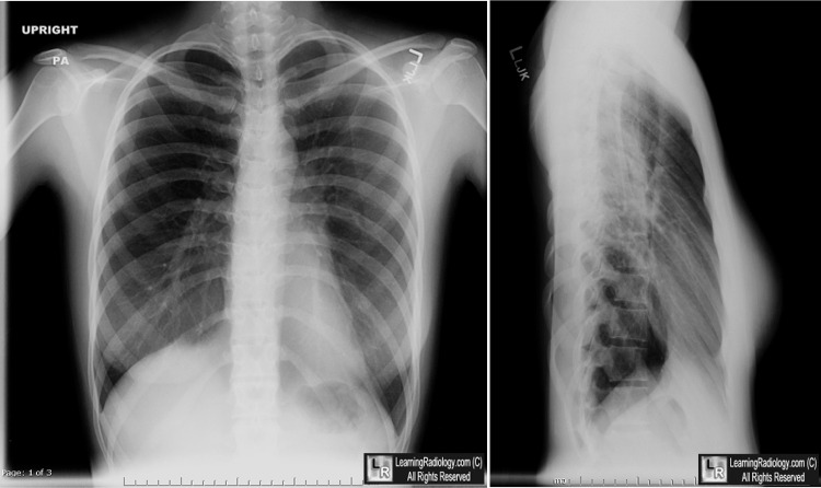 LearningRadiology - straight, back, syndrome, spine, thoracic